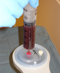Platelet Rich Plasma